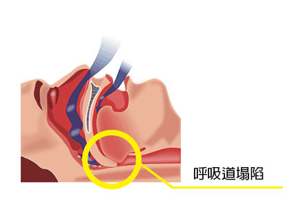 睡眠呼吸中止症 - 呼吸道塌陷圖